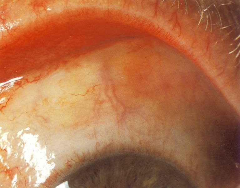 imagini alergia oculara